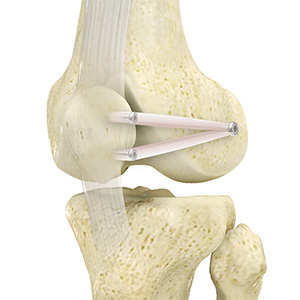 Patellofemoral Stabilisation