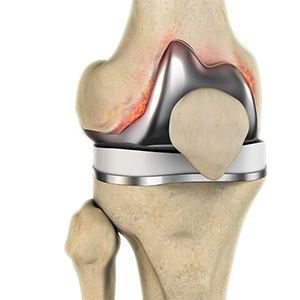 Periprosthetic Knee Infection