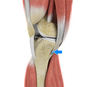 Pes Anserine Bursitis