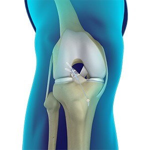 Primary ACL Repair