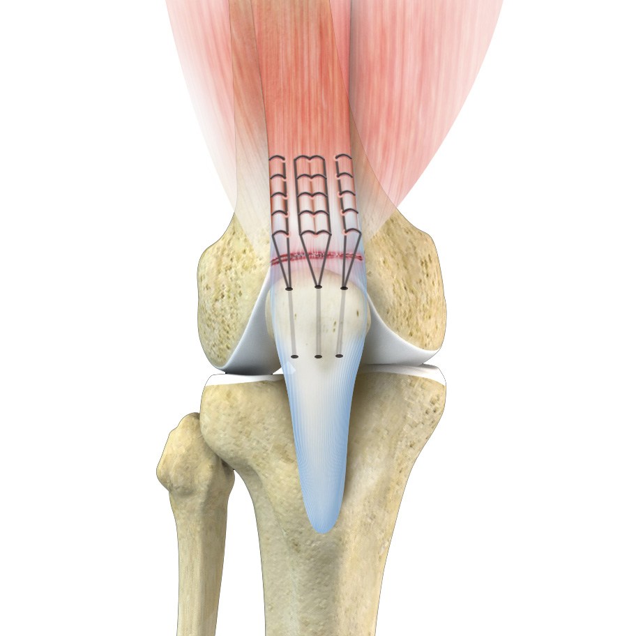 Minimally Invasive Knee Replacement Leicester Knee Arthroscopy Leicester