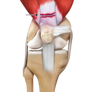 Quadriceps Tendon Rupture
