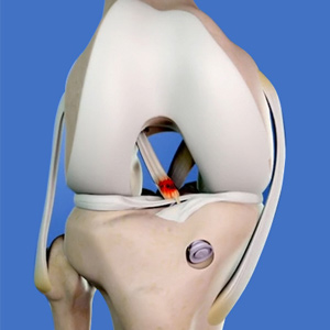 Revision ACL Surgery