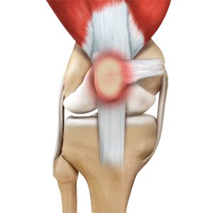 Runner's Knee