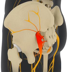 Sciatic Nerve Decompression