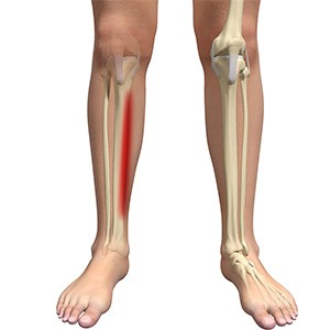 Shin Splints