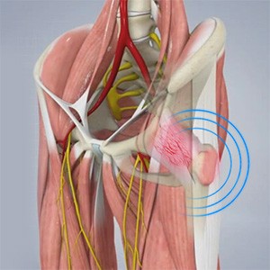 Snapping Hip Syndrome