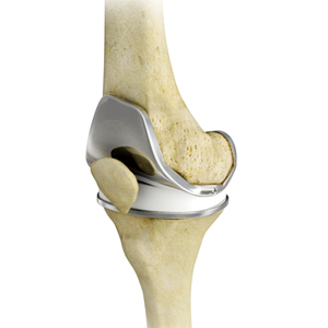 Total Knee Replacement