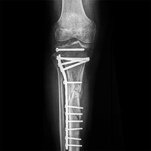 Traumatic Limb Salvage Surgery