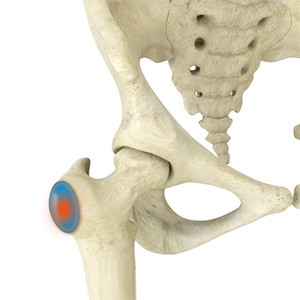 Trochanteric Bursitis