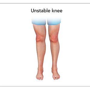 Unstable Knee