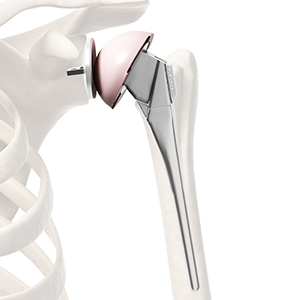 Anatomic Shoulder Arthroplasty