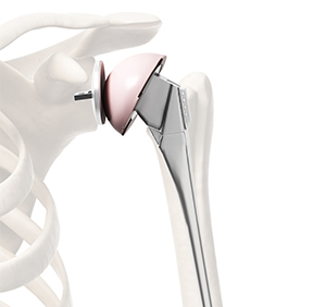 Anatomic Shoulder Arthroplasty