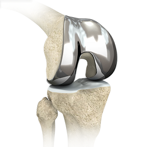 Custom-fitted Total Knee Arthroplasty Kansas City | Total Knee