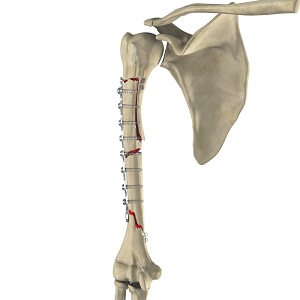 Complex Shoulder Reconstruction