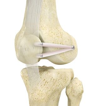 Patellofemoral Stabilization