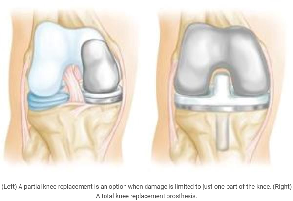 Knee Replacement