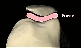 Knee Muscular imbalances