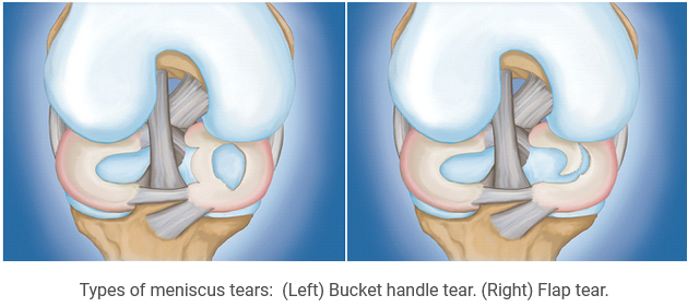 Meniscus Tears Description