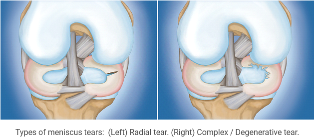 Meniscus Tears Cause