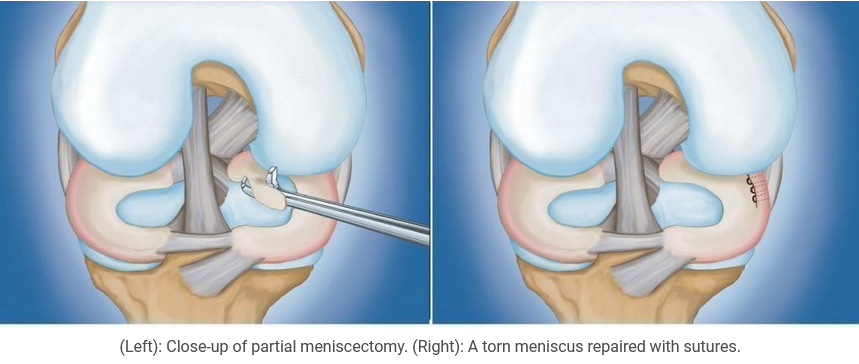 Meniscus repair