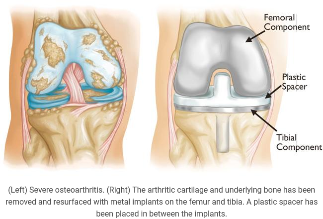 Total Knee Replacement procedures