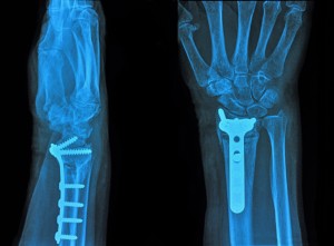 When your doctor says you have a fracture, do you know what they mean? 03