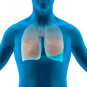 Sternotomy and Mediastinal Mass Excision