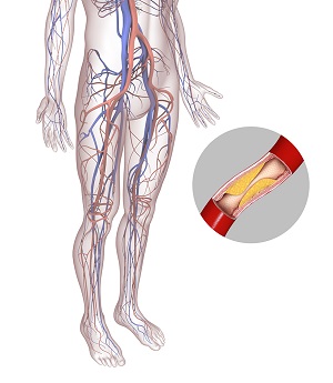 Peripheral Arterial Disease