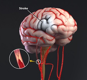 Stroke