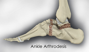 Ankle Arthrodesis
