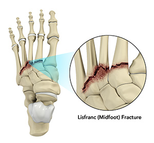 Lisfranc (Midfoot) Injury