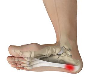 Plantar Fasciitis