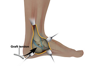Posterior Tibialis Tendon Repair