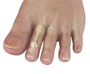 Toe Fractures
