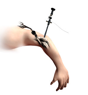 Elbow Arthroscopy