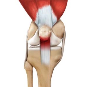 Jumper's Knee
