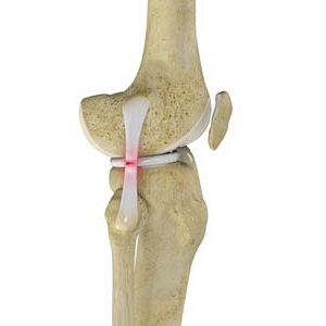 LCL Reconstruction