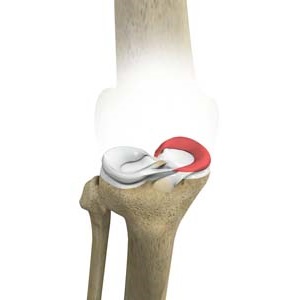 Medial Meniscus Syndrome