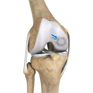 Osteochondritis Dissecans of the Knee