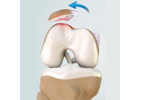 Patellofemoral Instability