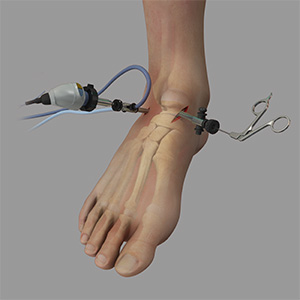 Ankle arthroscopy