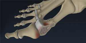 Foot and ankle osteotomy