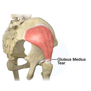 Gluteus Medius Tear