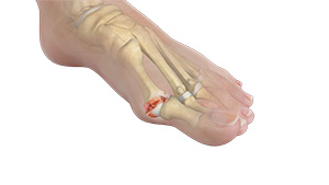 Hallux Rigiditis