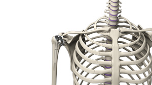Outpatient Shoulder Replacement