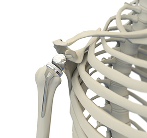 Reverse Shoulder Replacement