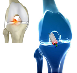 BEAR® Implant (Bridge-Enhanced ACL Restoration)