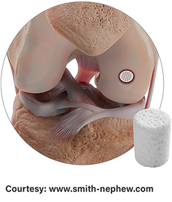 CartiHeal® Agili-C™ Knee Cartilage Restoration