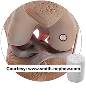 Knee Implants